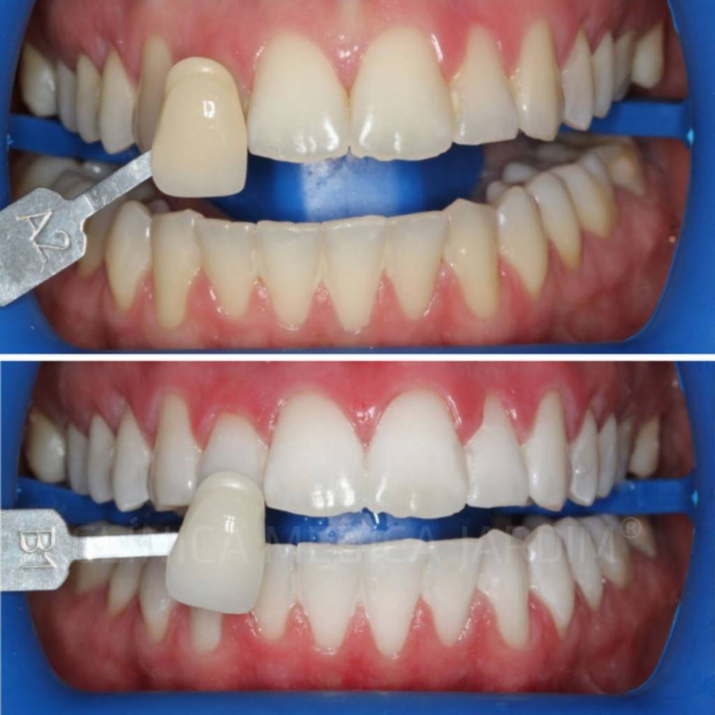 Clínica Médica Jardim - Branqueamento Dentário