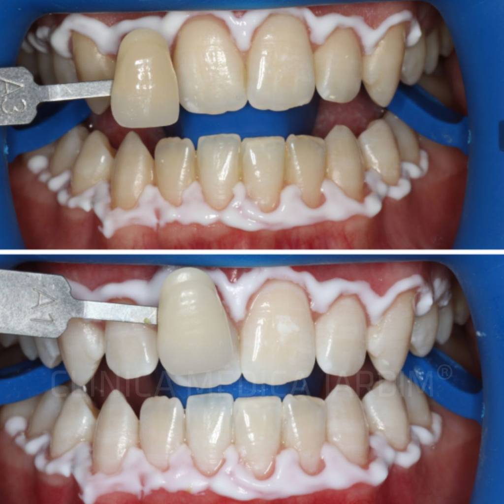 Clínica Médica Jardim - Branqueamento Dentário